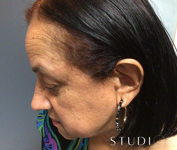 mole removal NYC results